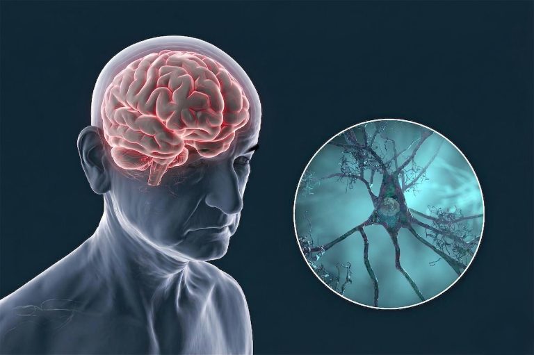 Οι επιστήμονες ζητούν μια πλήρη επανεξέταση της θεραπείας του Αλτσχάιμερ